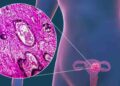 Prevén futuro alentador en terapias para cáncer de endometrio