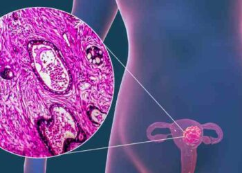 Prevén futuro alentador en terapias para cáncer de endometrio