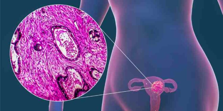 Prevén futuro alentador en terapias para cáncer de endometrio