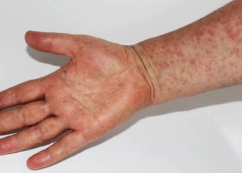 Sarampión en México: fallece niño de un año que no estaba vacunado en Tlaxcala